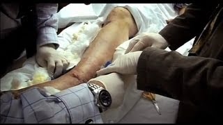 Worst Ankle Fracture Part 2  Bizarre ER [upl. by Natalina]