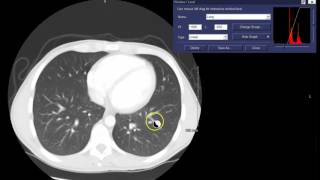 Window Width amp Window Level WL Concepts  CT Thorax Example [upl. by Tterab]