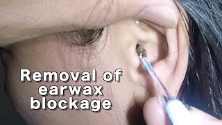 Dry Earwax Blockage Removal [upl. by Ilyah]