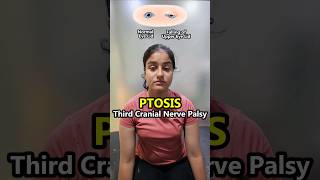 😭🥺 PTOSIS  Oculomotor nerve 3rd cranial nerve palsies Dropping of the eyelid  physiotherapy [upl. by Kimberly383]