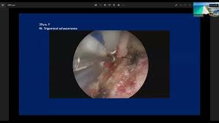 Endoscopic Kayhole Anterior Petrosal Approach to Petrous Lesions  Professor Takeo Goto [upl. by Steele123]