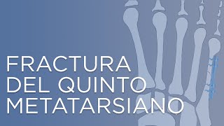 Fractura del quinto metatarsiano  IQTRA [upl. by Aneelehs799]