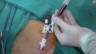 Permanent HD Cath insertion [upl. by Rosella]