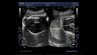 Ultrasound Video showing intrauterine fetal death with positive spalding sign and an encephalocele [upl. by Ynnaej]