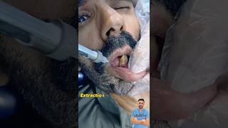 خلع سن يتحرك بشدة  Extraction of mobile teeth [upl. by Chiaki]