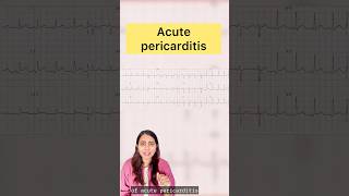 Acute pericarditis doctors pericarditis cardiology cardiologist echocardiagram ecg ecgc [upl. by Airasor]