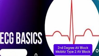 ECG Basics  Second Degree Mobitz type 2 Heart Block  Hay Block Causes of Mobitz II AV Block [upl. by Bivins15]