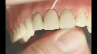 Dental Bridges [upl. by Asiul]