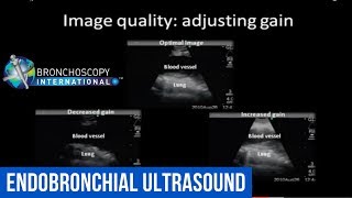 EBUS Physics Video  Endobronchial Ultrasound [upl. by Siger]