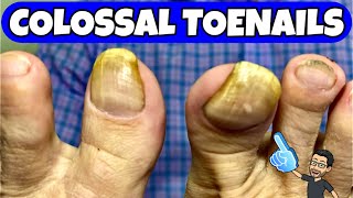 HUGE TOENAILS DEBRIDEMENT  LONG TIME NO SEE THE NIPPER [upl. by Lorie999]