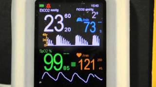 Cardiogenic Oscillations on VM2500M capnograph pulse oximeter [upl. by Canning]