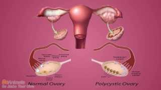 How to Permanently Cure Polycystic Ovary Syndrome PCOS [upl. by Goren]