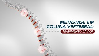 Metástases na coluna vertebral [upl. by Melisse444]