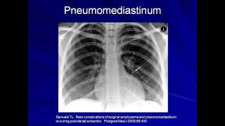 Lung Protective Ventilation Mechanical Ventilation  Lecture 9 [upl. by Alue]