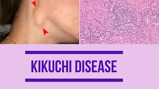 Kikuchi disease  Factors  Clinical features  Diagnosis  histopathology  Management [upl. by Einalem]