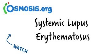 Systemic Lupus Erythematosus  Clinical Presentation [upl. by Ellen]