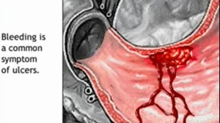 Stomach Ulcer Animation  Peptic Ulcer Disease Causes Symptoms Treatment  Gastric Anatomy [upl. by Linad]