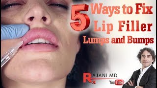 How to fix Lip Filler Bumps and LumpsWhy and How [upl. by Dosia]