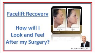 Facelift Recovery How will I Look and feel after my surgery [upl. by Jillana]