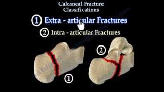 Calcaneal Fracture Classifications  Everything You Need To Know  Dr Nabil Ebraheim [upl. by Bertina800]