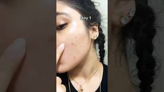 😌Remove pimple in overnight permanentlyOvernight Acne Treatment ytshorts viralvedios acneremoval [upl. by Hgielah]