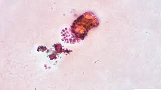 Thyroid cytology  Classical papillary thyroid carcinoma [upl. by Quitt132]