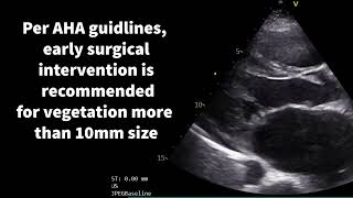 Cardiac vegetations in focus [upl. by Mathe]