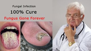 5 Way to Cure Fungal Infection on Skin Naturally [upl. by Mahgirb]