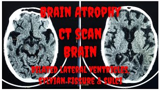 CT Scan of Brain  Brain Atrophy  CT Brain Findings  Age related cortical Atrophy Prasad Layek [upl. by Kirven]