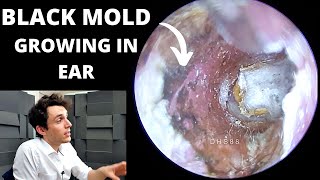 Black Mold Growing In Ear Canal Aspergillus Niger Fungus Extraction [upl. by Rimidalv]