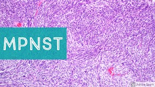 Malignant Peripheral Nerve Sheath Tumor MPNST 101Explained by a Sarcoma Pathologist [upl. by Alaikim]