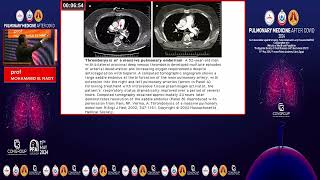 HIGH RISK PULMONARY EMBOLISM [upl. by Wadsworth]