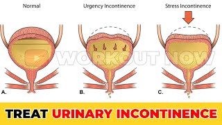 Pelvic Floor Exercises For Incontinence  Ttighten Pelvic Floor Muscles Quickly [upl. by Odlanyer]