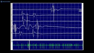 Kimura amp Kohara F32 Typical fasciculation potentials [upl. by Ollopa965]