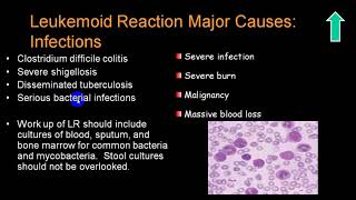 LEUKEMOID REACTION 4TH YR [upl. by Halimaj]