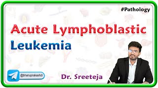 15 Acute Lymphoblastic Leukemia ALL  USMLE Step 1 Pathology [upl. by Aihsaei]