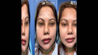 Nonsurgical Face Thread Lift V Lift  Fattan Polyclinic  Dubai [upl. by Ecam]