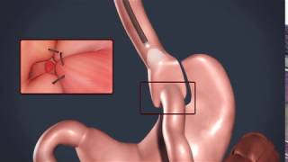 Overstitch Revision Bariatric Surgery in Chicago [upl. by Tarah]