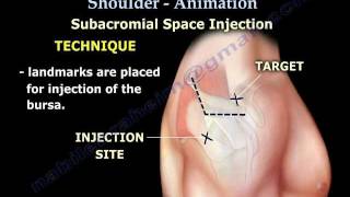 Shoulder bursitis Tendonitis Injection Animation  Everything You Need To Know  Dr Nabil Ebraheim [upl. by Raasch]