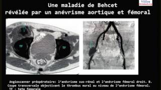 Une maladie de Behcet révélée par un anévrisme Cas Clinique [upl. by Yerhpmuh]