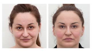 The results of dermal fillers before and after [upl. by Eerihs]