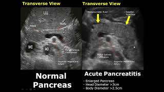 Pancreas Ultrasound Normal Vs Abnormal Image Appearances Comparison  Pancreatic Pathologies USG [upl. by Alleira]