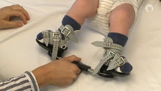 Clubfoot Stretches  Ponseti Brace  Module 4 [upl. by Coralie687]