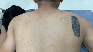 ACNE TREATMENT VU QUYNH MI  Acne On Back 2024 [upl. by Ynttirb281]