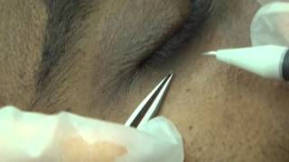 Skin tag removal from under eye [upl. by Jerrylee]