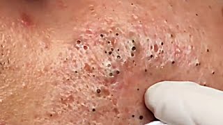 So Scary  Removal Of Deep Blackheads On Man Face [upl. by Lewse]