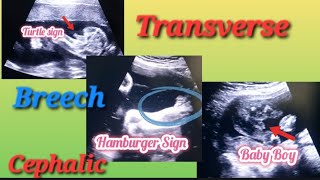 Transverse Breech amp Cephalic Baby In Uterus Genderreveal  Anterior Posterior Placenta Baby Gender [upl. by Navy]