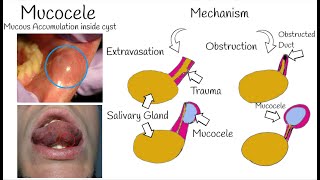 Oral Mucocele  The Most Common Mucosal lesion  Mucous Cyst Symptoms Causes amp Treatment [upl. by Adnovaj]