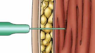 Pharmacology IM Absorption [upl. by Manvel]