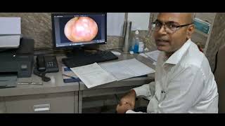 mastoidectomy result entspecialist doctor aakriti mastoidoperationviraltrendinghealth [upl. by Erica]